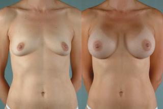 Результаты применения BreastActives Plus для увеличения груди